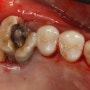 신경치료후 치아관리