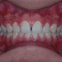 [치아 틈 교정]앞니 치아 틈 미+교정증례