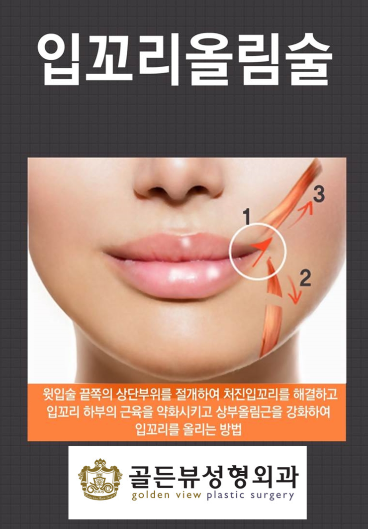 입꼬리수술 방법중 무흉 입꼬리수술(입속 점막절제)에 대해.. : 네이버 블로그