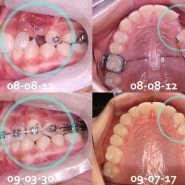 치아교정에 관한 수필로그 - 치아의 맹출과 교환