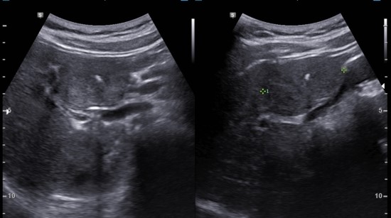 국소결절과형성(FNH, focal nodular hyperplasia) 의심, 간 양성 종양 : 네이버 블로그