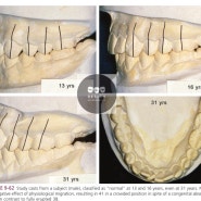 치아교정에 관한 수필로그 - ‘시나브로, 삐뚤어진 아래 앞니’ 이야기