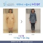 위밴드수술 1년 후 46.8kg 감량 전후사진