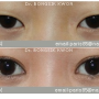 트임성형외과의 자연스러운 눈성형사례 (권봉식원장)