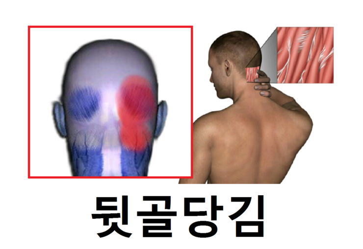 뒷골이 땡길때 극심하다면 근본적으로 : 네이버 블로그