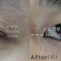 눈재수술:쌍꺼풀 푸는 수술 Removal of double fold 解开双眼皮