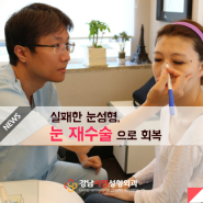[ 눈재수술잘하는병원 강남서연성형외과 뉴스] 실패한 눈성형, 눈 재수술로 회복해볼까