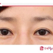 짝눈교정, 짝눈수술 사례 설명