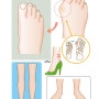 무지외반증 수술 후 관리, 언제부터 걸을 수 있나요?