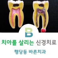 [행당동바른치과] 치아를 살리는 신경치료