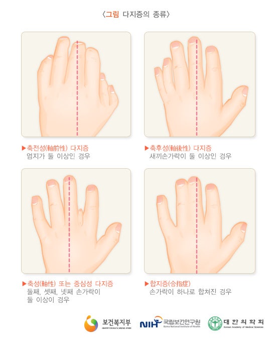 [신촌연세병원/수부센터] 손가락이 6개 이상, 다지증이란? _1부 (의미/증상/종류/원인) : 네이버 블로그