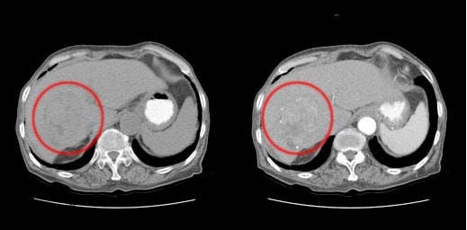 [간] 간암(Hepatocellular carcinoma) : 네이버 블로그