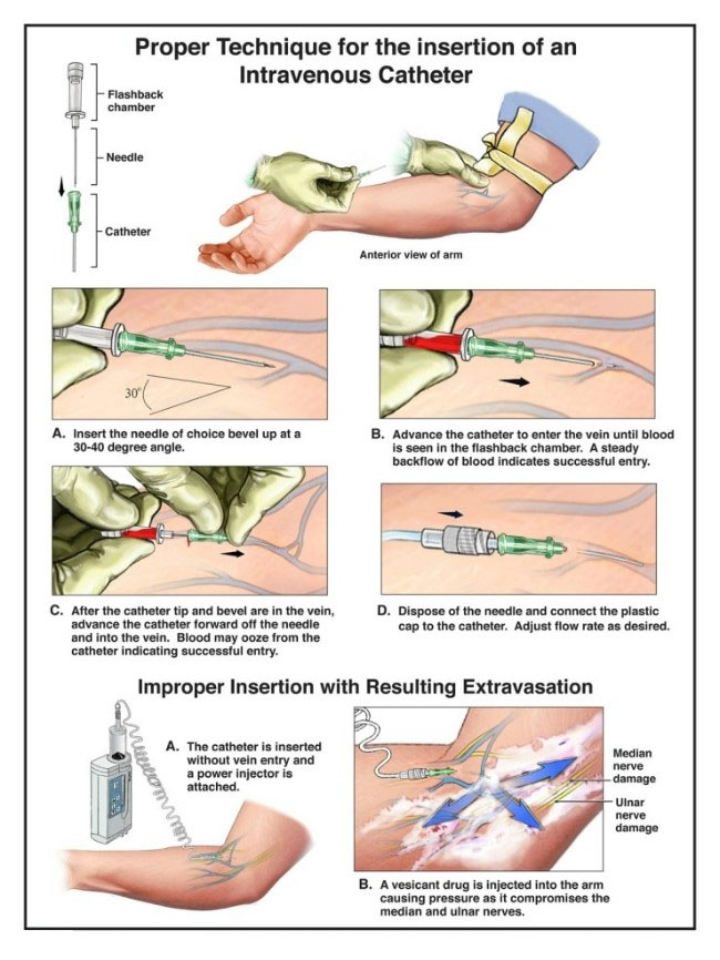 How To Find A Good Iv Site