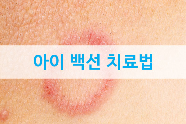 [육아정보] 아이 백선 증상, 어떻게 치료하나요? : 네이버 블로그