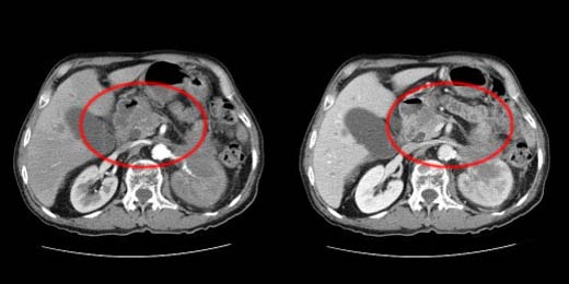 [췌장] 췌장암 (pancreatic cancer) : 네이버 블로그