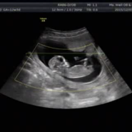 [ 8주 ] 산전검사, 피말리던 4주, 임신 톡소플라즈마 재검ㅠㅠ