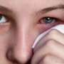 결막염 : 눈병, 결막염 원인 및 증상, 결막염 치료 방법