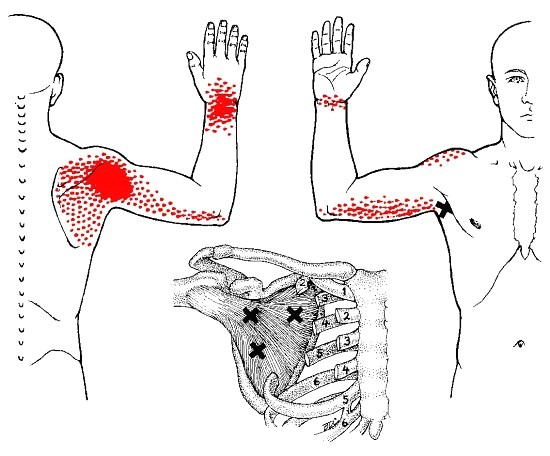 [견갑하근 Subscapularis] 날개뼈 어깨 손목통증 극하근의 주동길항근 용인수지죽전 : 네이버 블로그