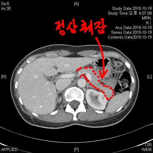 복강경 췌장 원위부 절제술 : 네이버 블로그