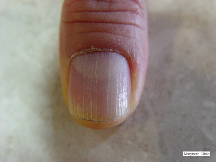 137. 손발톱세로능선 (Longitudinal ridge) - 피부질환 백과사전﻿﻿ : 네이버 블로그