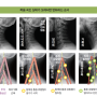목 디스크의 양한방 협진 치료