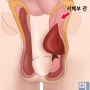 서혜부탈장에 대하여