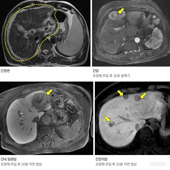 간 자기공명영상[MRI] : 네이버 블로그