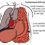Congenital diaphragmatic hernia 선천성 횡경막 탈장