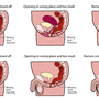 Imperforate anus 무공성 항문 (Anorectal malformation, 직장항문기형)