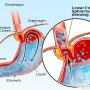 Gastroesophageal reflux disease 위식도역류질환