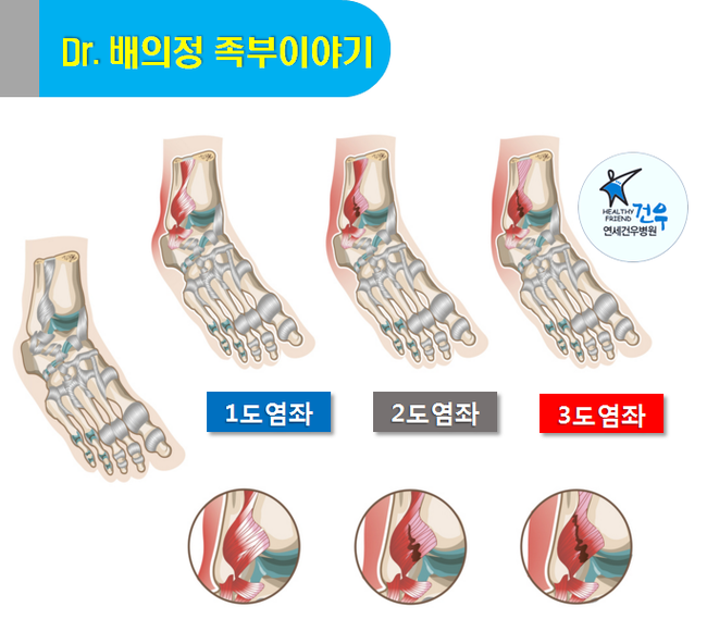 발목인대파열 부상, 인대복원술로! : 네이버 블로그