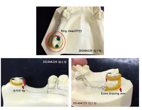 국소의치 실습_Ring clasp Wax-up& RPA clasp 디자인 : 네이버 블로그