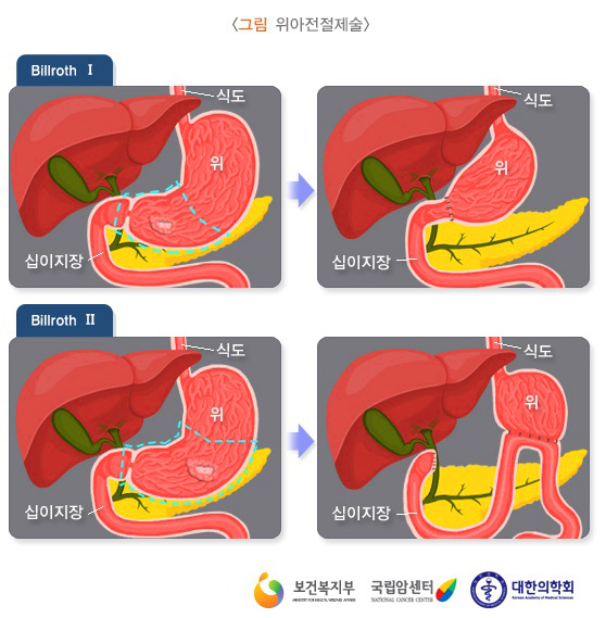 위암 치료방법 - 수술종류와 항암치료 : 네이버 블로그