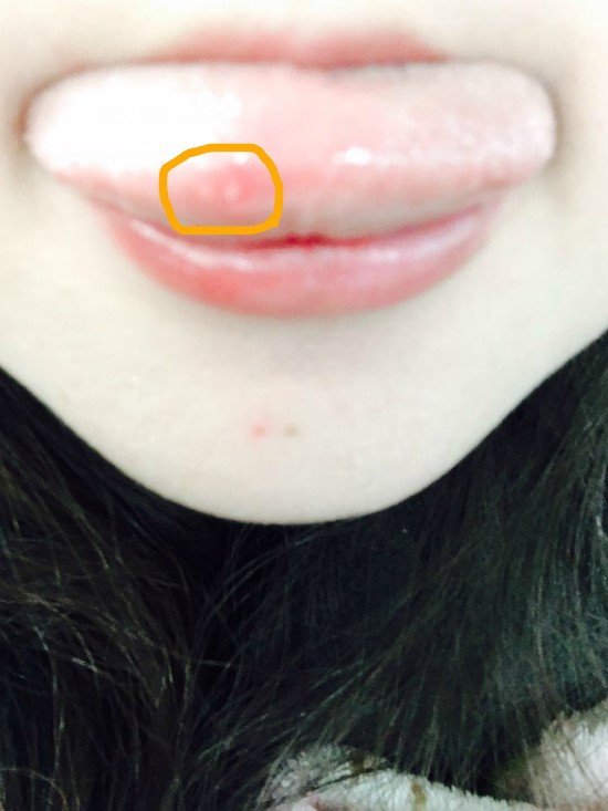 설염때문에 너무 아프네요 치료는?! : 네이버 블로그