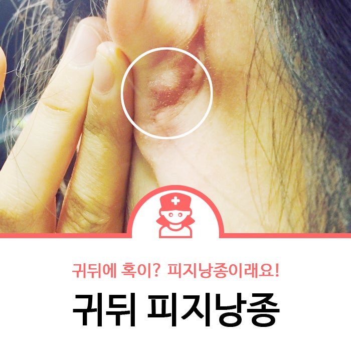귀뒤피지낭종, 귀 뒤에 혹이 생겼다면 ? (WB.병원처자) : 네이버 블로그
