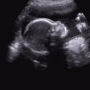 임신 23주 강철심장