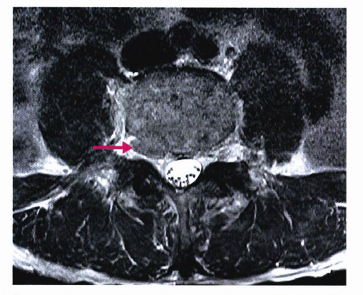 허리디스크: 요추 추간판 탈출증 (Herniated Inter-vertebral Disc) : 네이버 블로그