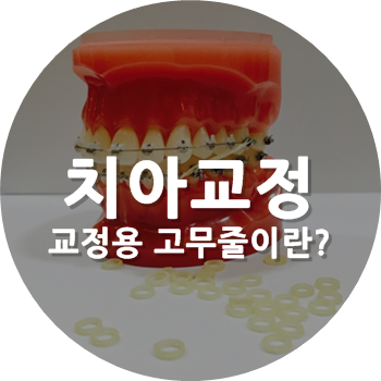 Orthodontics Treatment for Underbite or Crossbite - Rubber Bands 