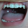 19개월 치아우식증 경희대소아치과에서 투스무스 치아영양제처방