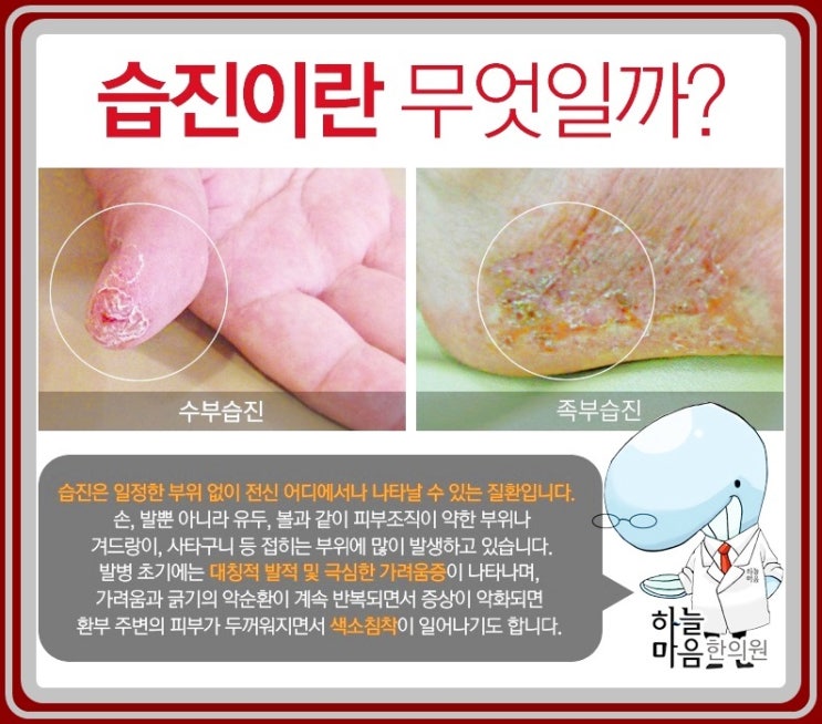 습진표피수축,습진탈피,습진홍반 : 네이버 블로그