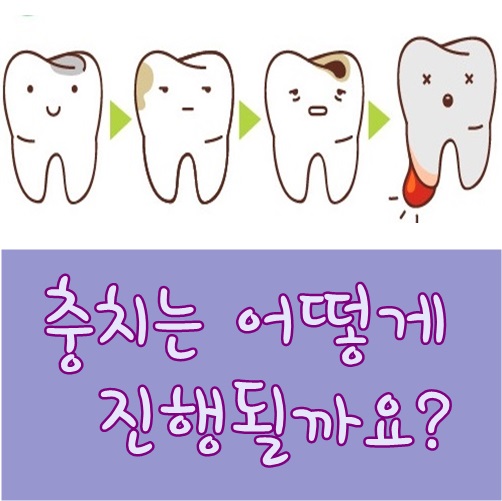 충치단계와 치아우식증에 대해 알아보자 : 네이버 블로그 충치단계와 치아우식증에 대해 알아보자 : 네이버 블로그