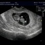 [임신9주-11주] 젤리곰 하루, 입덧의절정