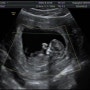 [임신12주-13주] 1차 기형아검사, 입체초음파,12주의 기절