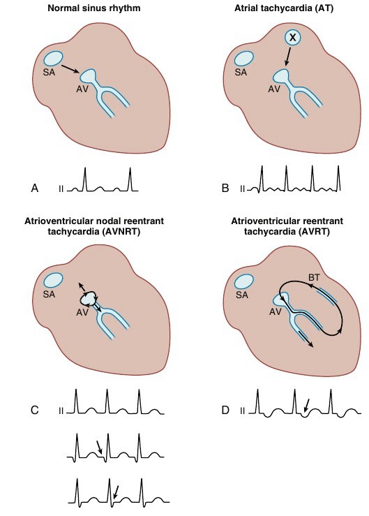 Paroxysmal Supraventricular Tachycardia Psvt 네ì´ë²„ ë¸