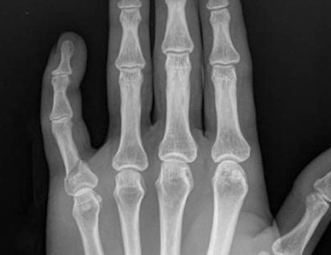 제 2-5 수지 지골 골절(2nd~5th phalanx fracture) : 운동 중에 넘어지면서 손가락이 부러졌어요 : 네이버 블로그