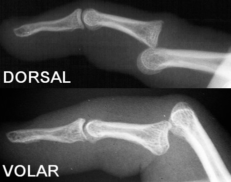 수지간 관절 탈구 및 인대 손상(PIP & DIP joint dislocation and ligament injury) : 운동 ...