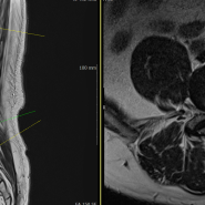 다리저림으로 발현된 후종인대골화증에 대한 후궁성형술