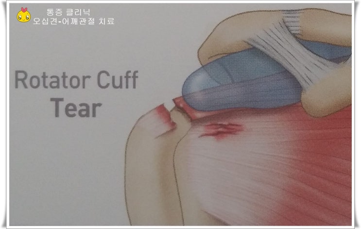 어깨통증(2), 회전근계파열, : 네이버 블로그