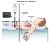 arterial catheter transducer