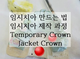 임시치아 제작 과정 만드는 법 만들기 Temporary crown Jacket crown : 네이버 블로그